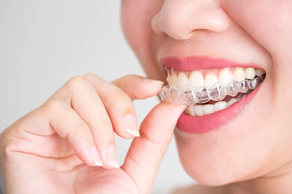 Invisalign Aligner
