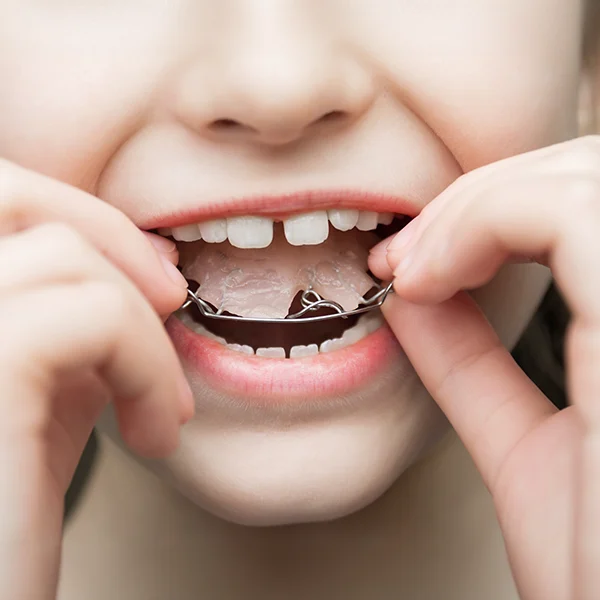 Lose Zahnspange Bornheim Lose Zahnspange Bornheim