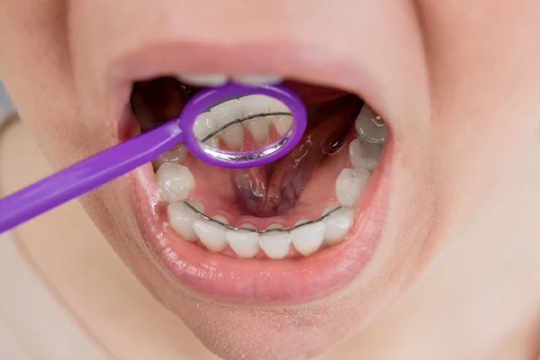 Retainer Nachbehandlung Zahnspange